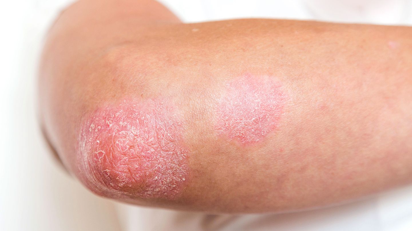 psoriasis