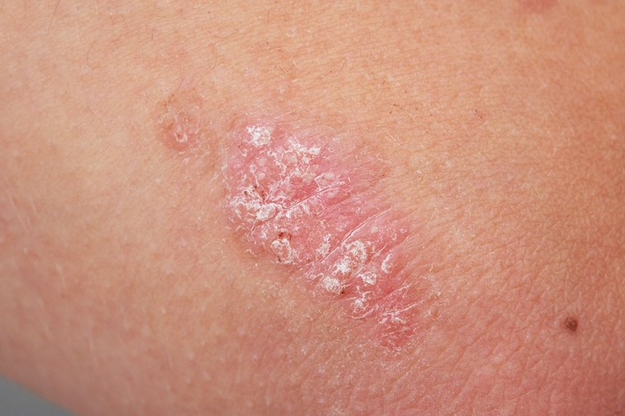 PUVA und NB-UVB bleiben eine wirksame Behandlung gegen Psoriasis; Mai 2021 Forschung
